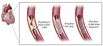 Ứng dụng kỹ thuật can thiệp động mạch vành qua da trong điều trị bệnh nhân đau thắt ngực ổn định